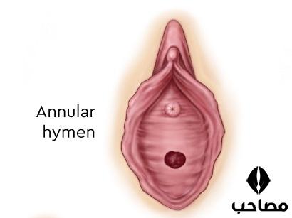 پرده حلقوی